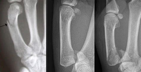 long bone compression test for metacarpal fractures|metacarpal fracture management pdf.